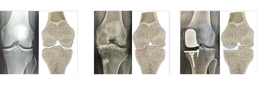 prothese arthrose genou prothese pour arthrose du genou gonarthrose prothese docteur anthony wajsfisz chirurgien orthopediste specialiste du genou a paris