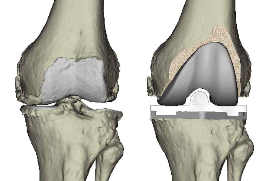 prothese du genou nouvelle generation 2019 prothese genou avis prothese de genou totale docteur anthony wajsfisz chirurgien orthopediste specialiste du genou a paris