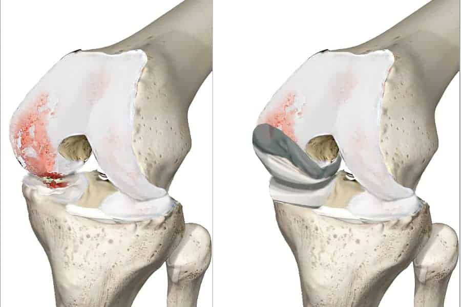 prothese femur protheses tibiales puc genoux puc interne genou docteur anthony wajsfisz chirurgien orthopediste specialiste du genou a paris