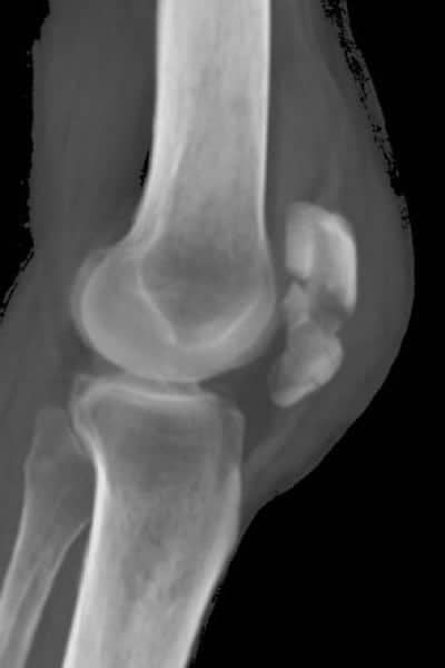 radio d une fracture comminutive de la rotule deplacee docteur anthony wajsfisz chirurgien orthopediste specialiste du genou a paris