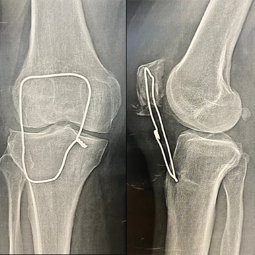radio du tendon rotulien radio tendon genou docteur anthony wajsfisz chirurgien orthopediste specialiste du genou a paris