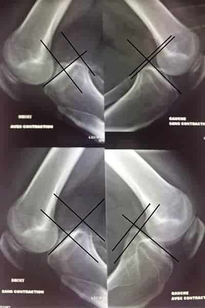 radio ligament genou radiographie de genou ligament radio genoux docteur anthony wajsfisz chirurgien orthopediste specialiste du genou a paris