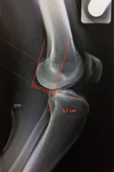 radio telos radiologie du genou docteur anthony wajsfisz chirurgien orthopediste specialiste du genou a paris