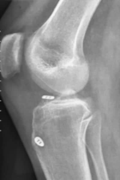 radiographie de fixation des epines tibiales anatomie docteur anthony wajsfisz chirurgien orthopediste specialiste du genou a paris