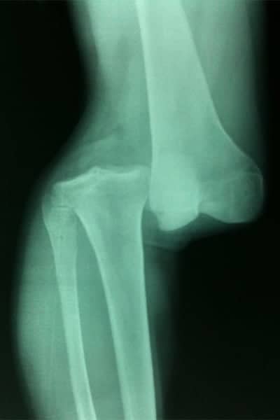 radiographie de genou radio genou ligament radio du genou comment ca se passe docteur anthony wajsfisz chirurgien orthopediste specialiste du genou a paris