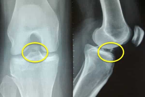 radiographie epine tibiale définition epine tibiale genou docteur anthony wajsfisz chirurgien orthopediste specialiste du genou a paris
