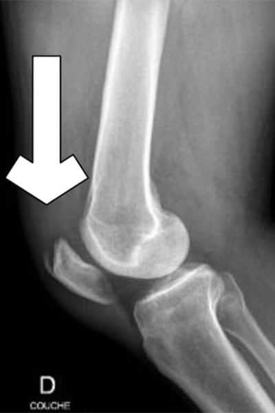 rotule deplacee rotule deplacer rotule desaxee radio du genou docteur anthony wajsfisz chirurgien orthopediste specialiste du genou a paris