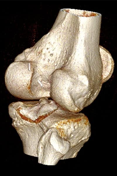 scanner du genoux comment se passe un scanner du genou 3D scanner ligament croise docteur anthony wajsfisz chirurgien orthopediste specialiste du genou a paris