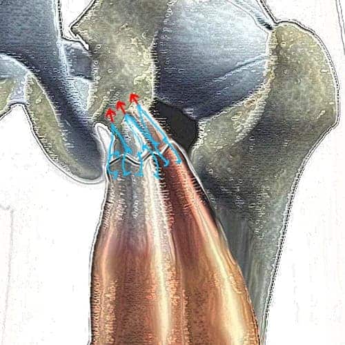 suture du tendon ischio-jambier sur os tendon ischio jambier genou docteur anthony wajsfisz chirurgien orthopediste specialiste du genou a paris