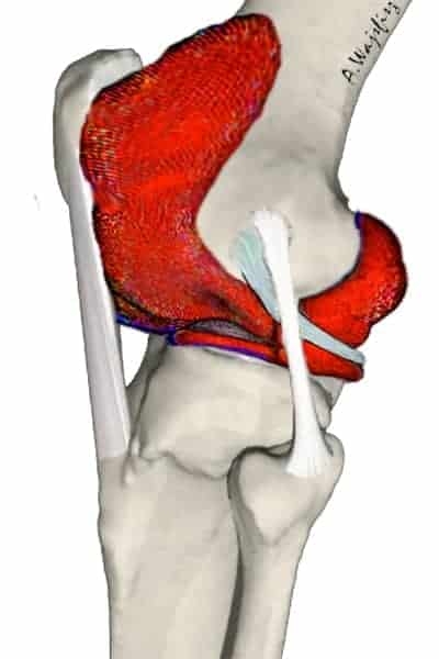 synovite genoux synovite inflammatoire synovite articulaire docteur anthony wajsfisz chirurgien orthopediste specialiste du genou a paris