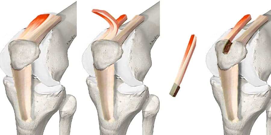 tendon du quadriceps tendon quadricipital genou tendon quadricipital du genou docteur anthony wajsfisz chirurgien orthopediste specialiste du genou a paris