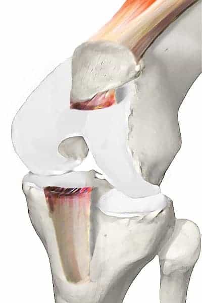 tendon patellaire tendon rotulien genou tendon rotulien rupture docteur anthony wajsfisz chirurgien orthopediste specialiste du genou a paris