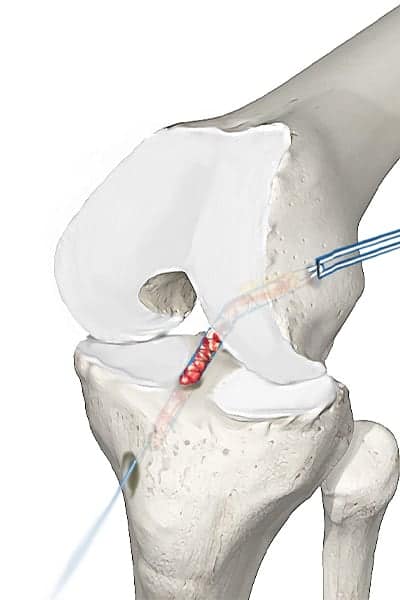 transplant de ligament croise anterieur docteur anthony wajsfisz chirurgien orthopediste specialiste du genou a paris