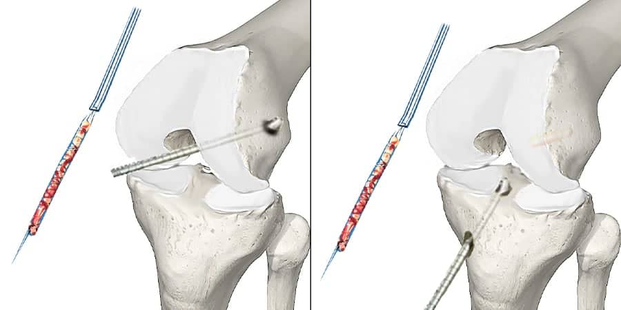 tunnel tibial tunnel ligamentoplastie arthroscopie du genou arthroscopie genou cicatrice docteur anthony wajsfisz chirurgien orthopediste specialiste du genou a paris