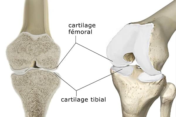 ulceration cartilage genou fissure cartilage genou usure cartilage du genou docteur anthony wajsfisz chirurgien orthopediste specialiste du genou a paris