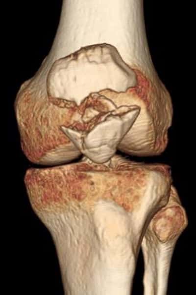 fracture rotule genoux scanner du genoux comment se passe un scanner du genou passer un scanner du genou docteur anthony wajsfisz chirurgien orthopediste specialiste du genou a paris
