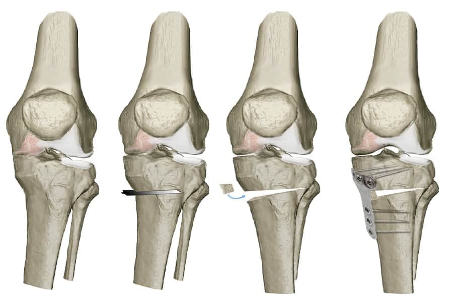 osteotomie tibiale de valgisation osteotomie tibiale taux de reussite docteur anthony wajsfisz chirurgien orthopediste specialiste du genou a paris