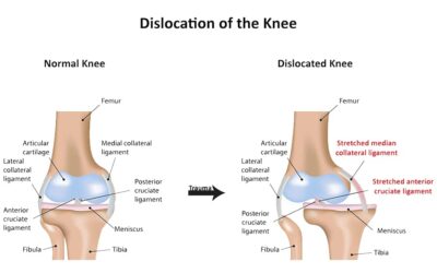 La luxation du genou : rupture des ligaments croisés et latéraux