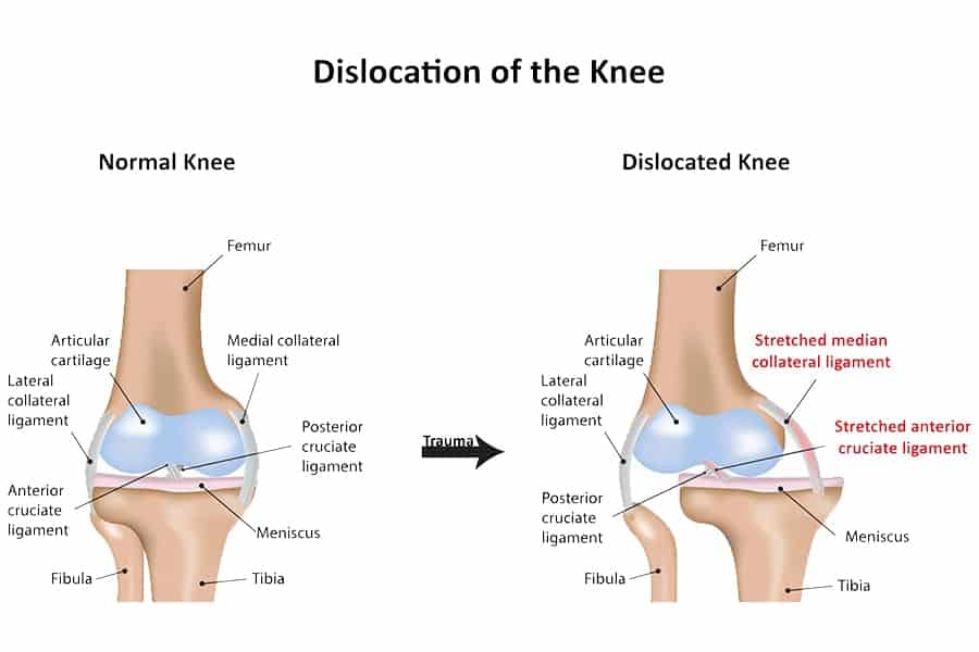 luxation genou rupture des ligaments croises et lateraux