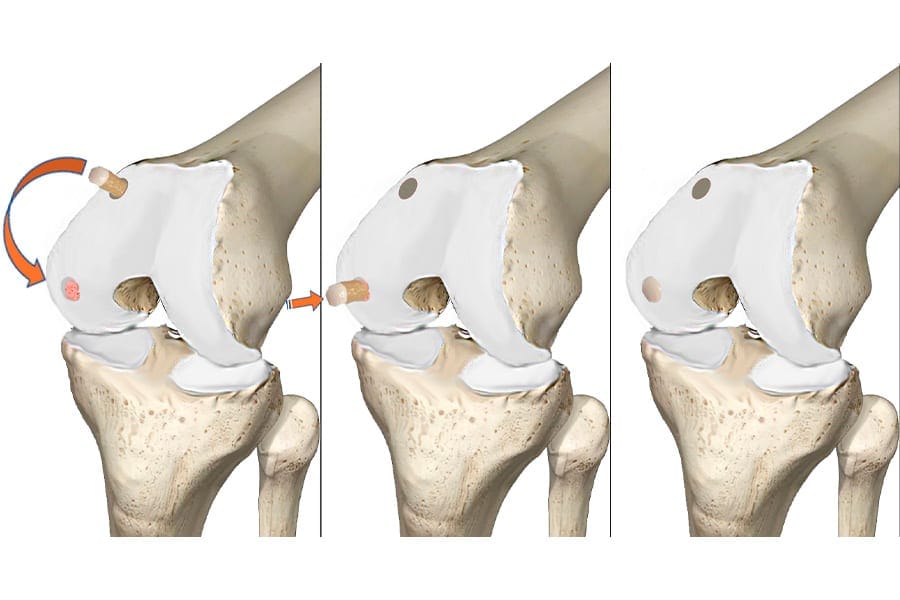 mosaicoplastie docteur anthony wajsfisz chirurgie orthopedique du genou paris
