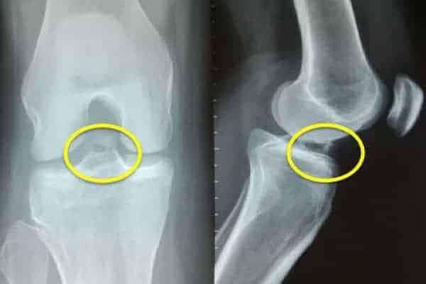 radiographie epine tibiale définition epine tibiale genou docteur anthony wajsfisz chirurgien orthopediste specialiste du genou a paris radiographie epine tibiale définition epine tibiale genou docteur anthony wajsfisz chirurgien orthopediste specialiste du genou a paris